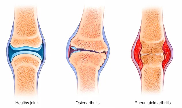 Arthritis Symptoms and causes