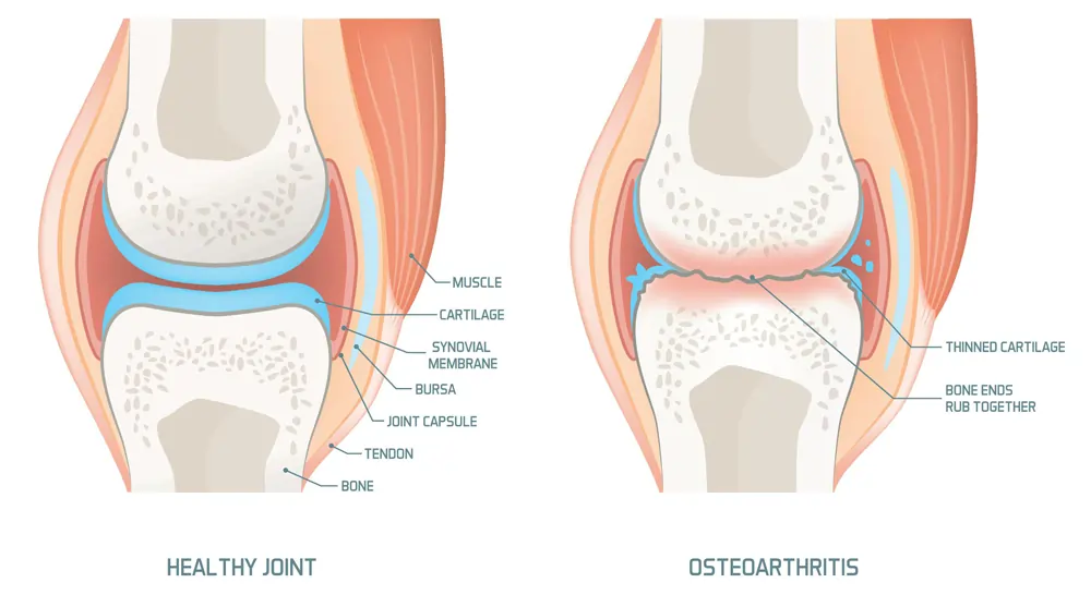 What is osteoarthritis (OA)