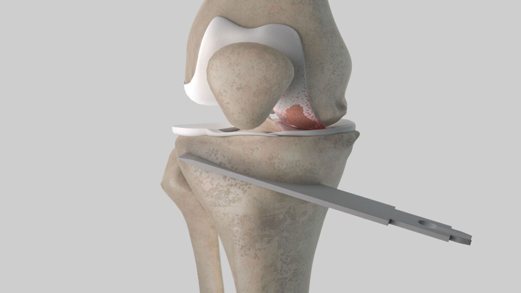 osteotomy