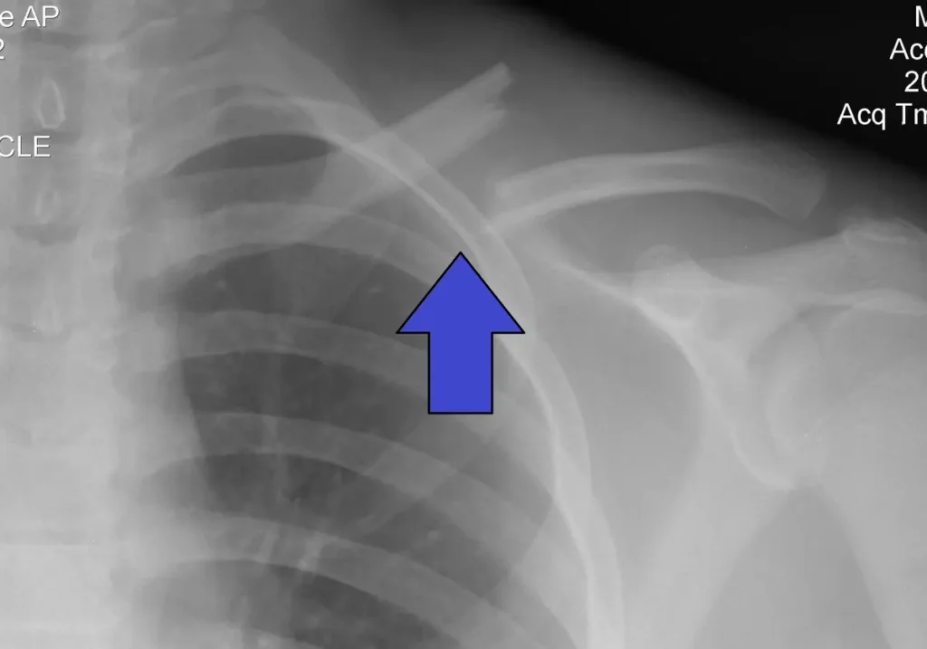 Collarbone or Clavicle Fracture