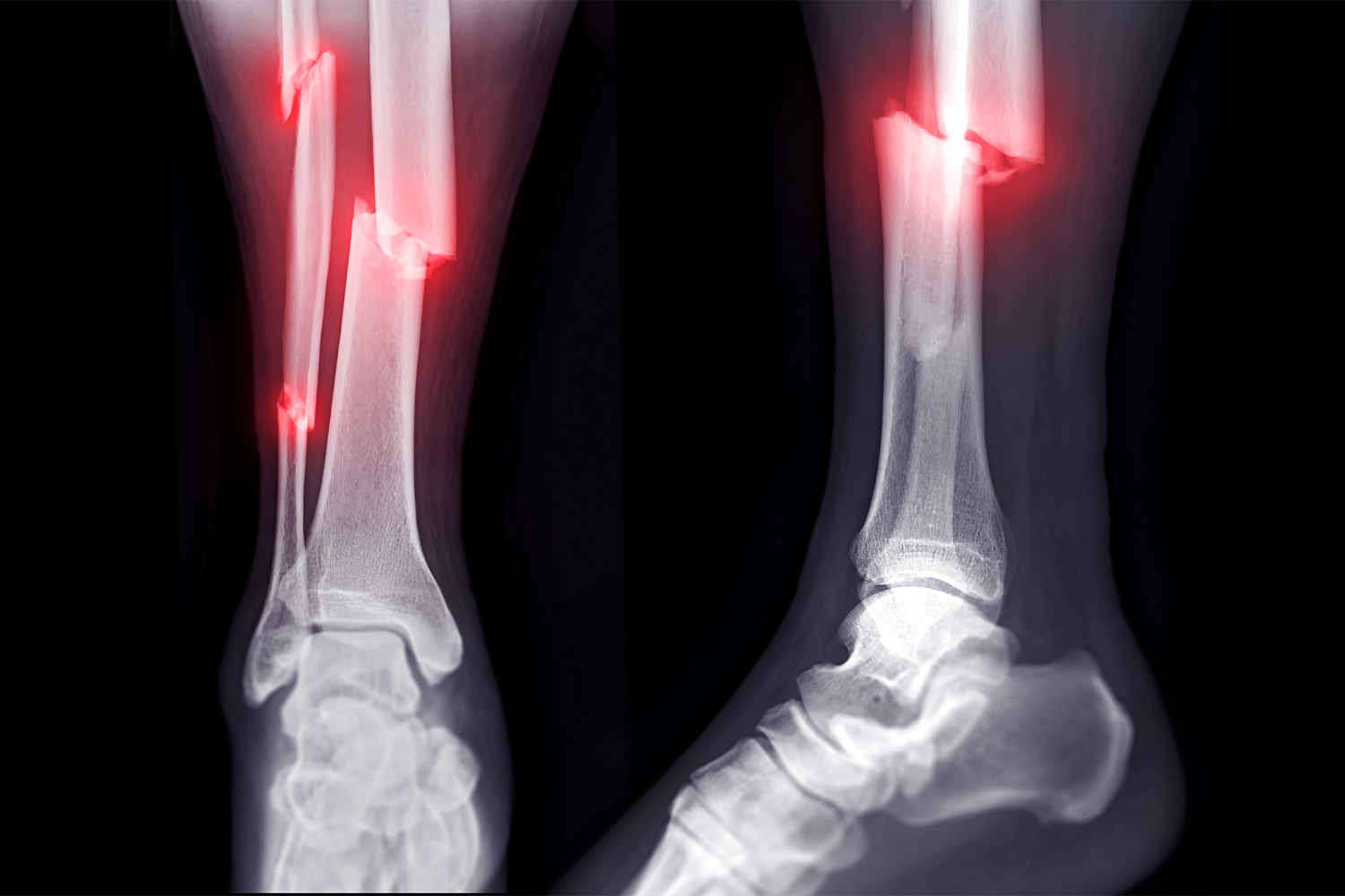 Diagnosing bone fractures