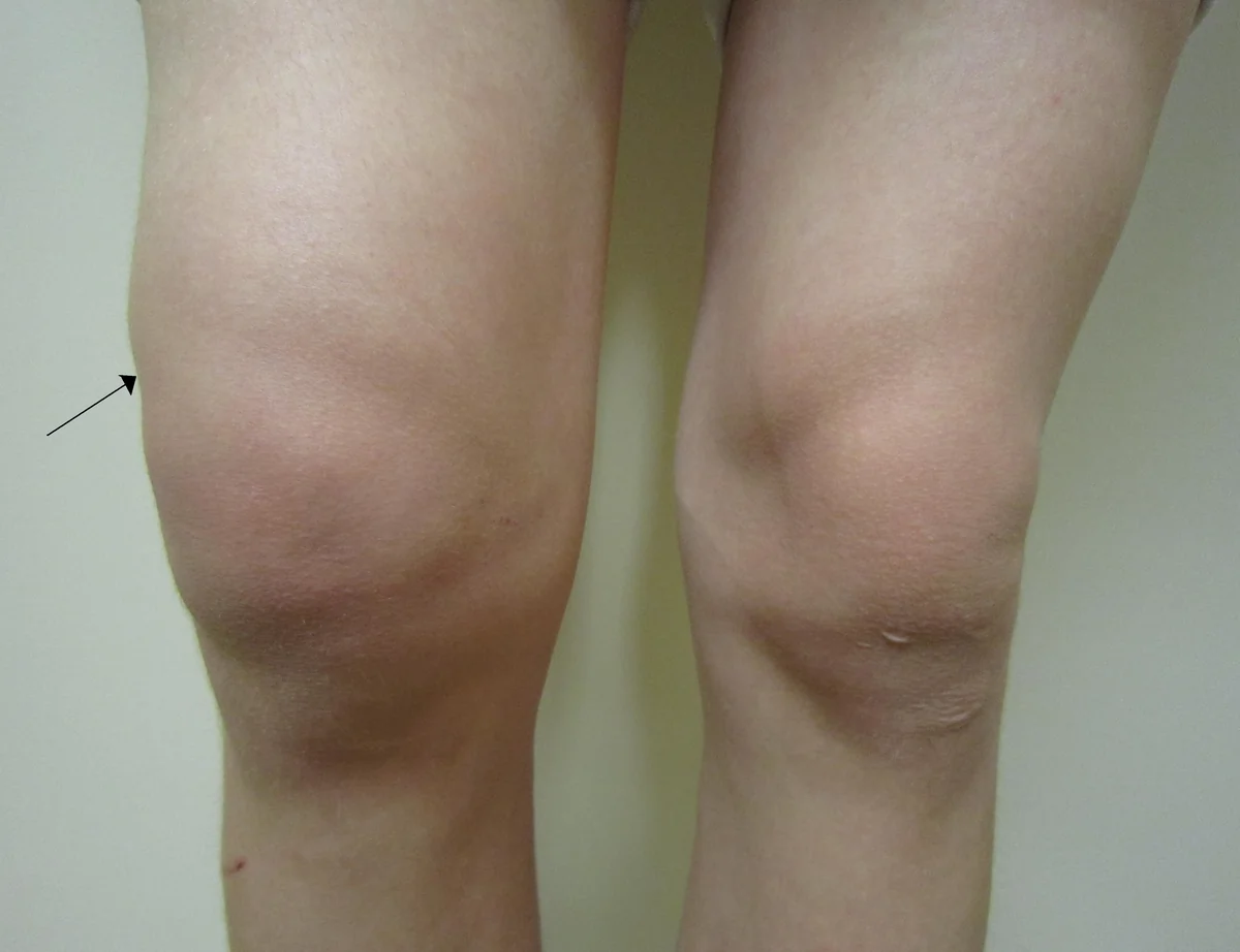 Knee Effusion