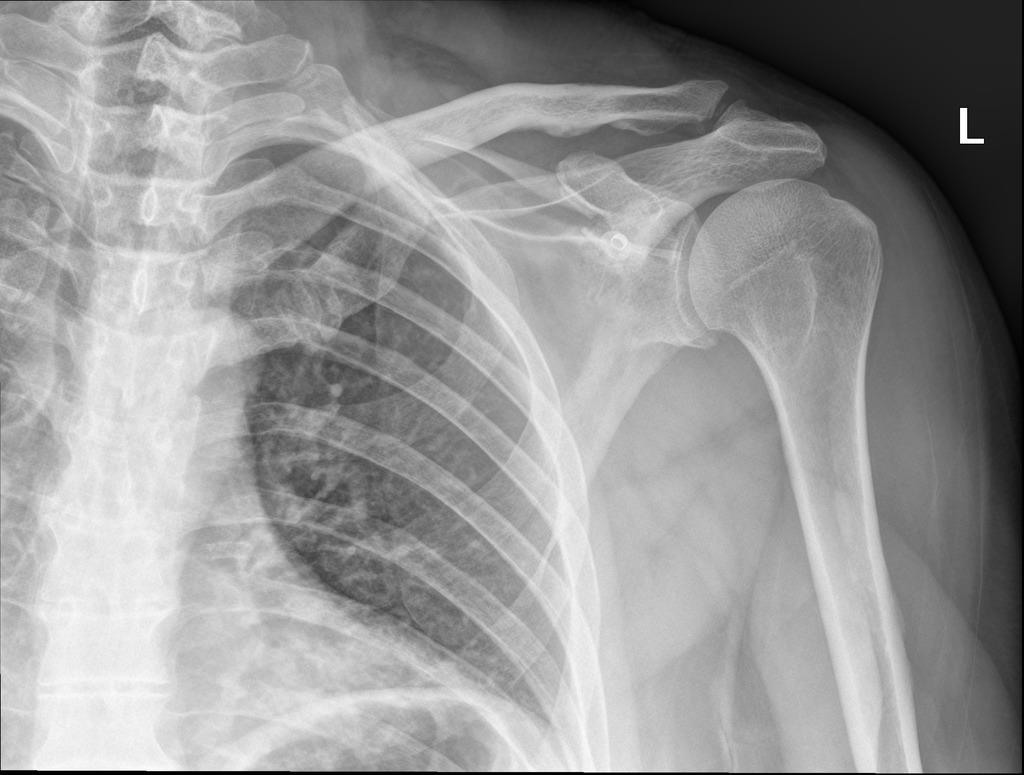 Shoulder Bone Fracture