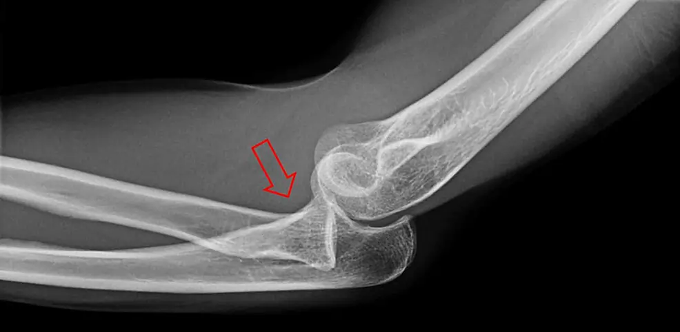 Dislocation of the Radial Head in the Elbow Joint