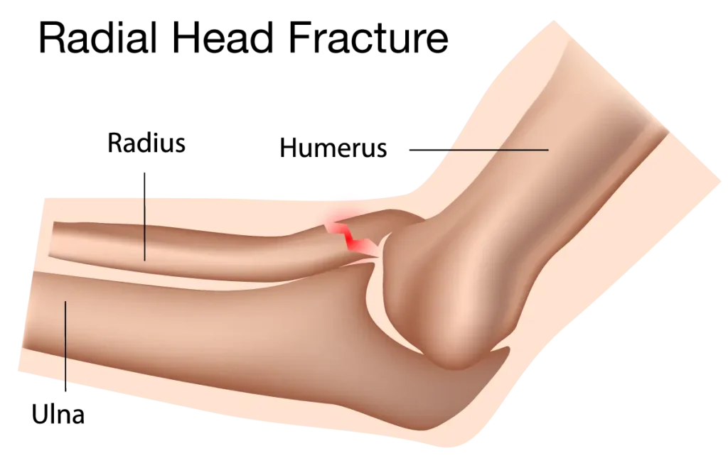Fracture of the Radial Head in the Elbow Area