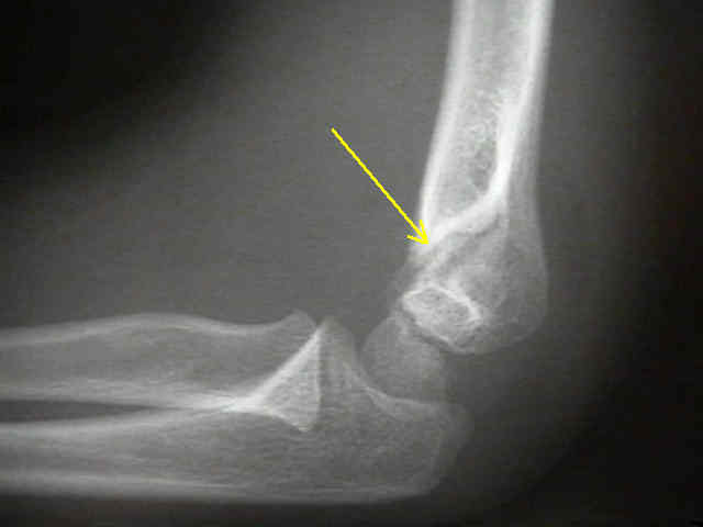 Lateral Condyle Fracture in Children