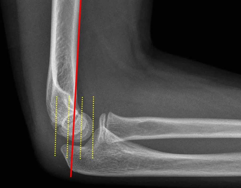 Supracondylar Elbow Fractures in Adults