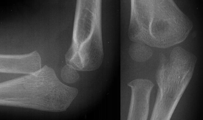 Supracondylar Elbow Fractures in Children