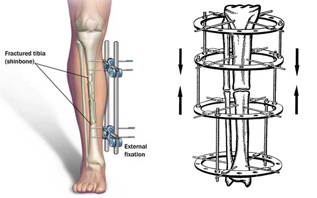 The Fascinating History and Evolution of Limb-Lengthening Surgery ...